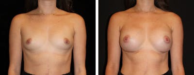 Breast Augmentation Before & After Gallery - Patient 249616 - Image 1