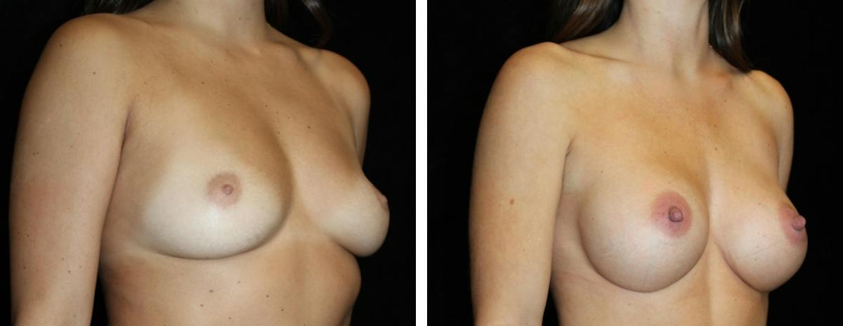 Breast Augmentation Before & After Gallery - Patient 283964 - Image 2