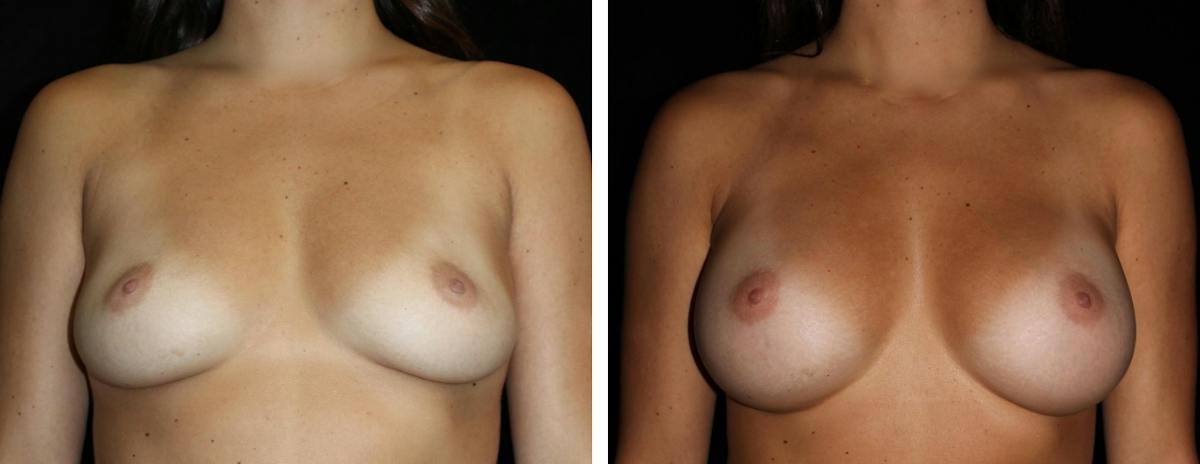 Breast Augmentation Before & After Gallery - Patient 283964 - Image 1