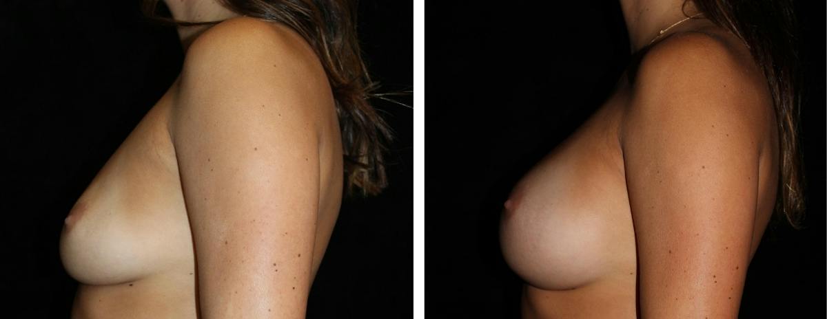 Breast Augmentation Before & After Gallery - Patient 283964 - Image 3