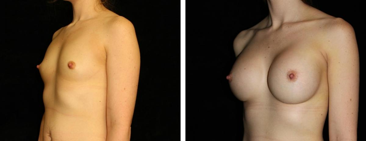 Breast Augmentation Before & After Gallery - Patient 326057 - Image 2