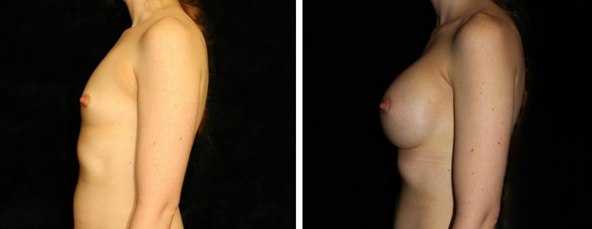 Breast Augmentation Before & After Gallery - Patient 326057 - Image 3