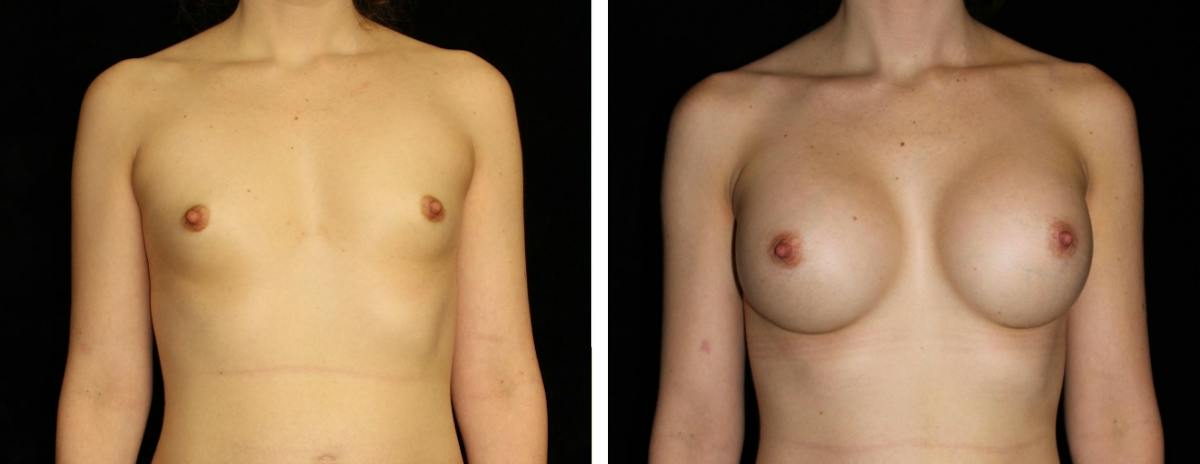 Breast Augmentation Before & After Gallery - Patient 326057 - Image 1