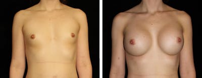Breast Augmentation Before & After Gallery - Patient 326057 - Image 1