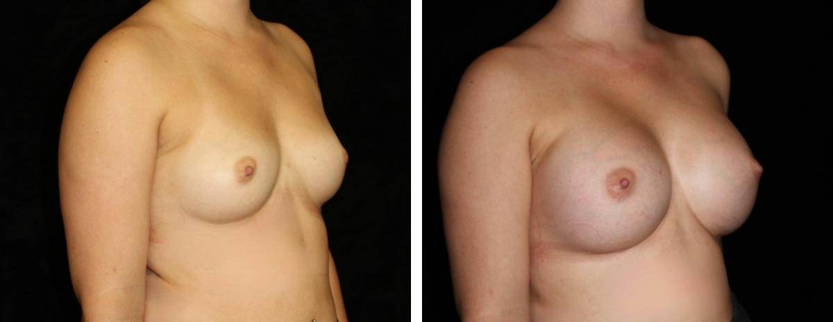 Breast Augmentation Before & After Gallery - Patient 101817 - Image 2