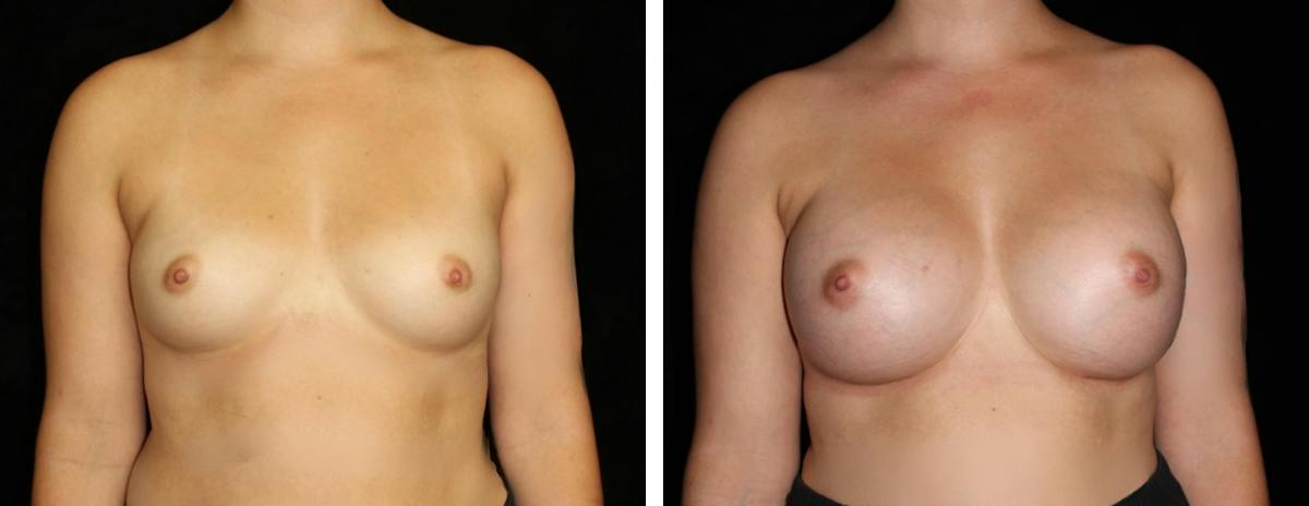 Breast Augmentation Before & After Gallery - Patient 101817 - Image 1