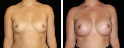 Breast Augmentation Before & After Gallery - Patient 101817 - Image 1