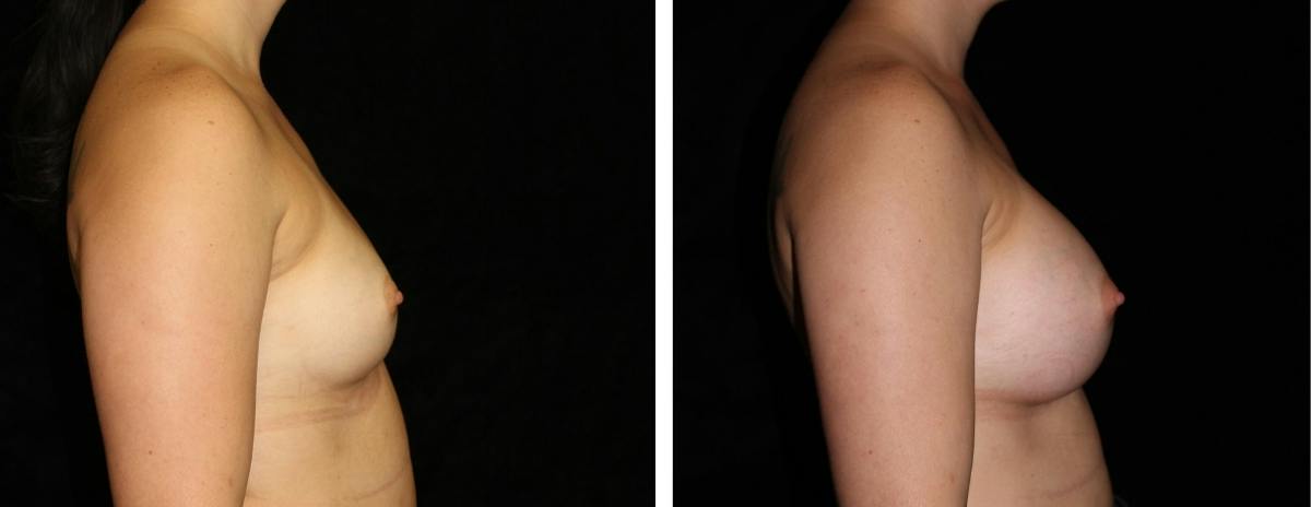 Breast Augmentation Before & After Gallery - Patient 101817 - Image 3