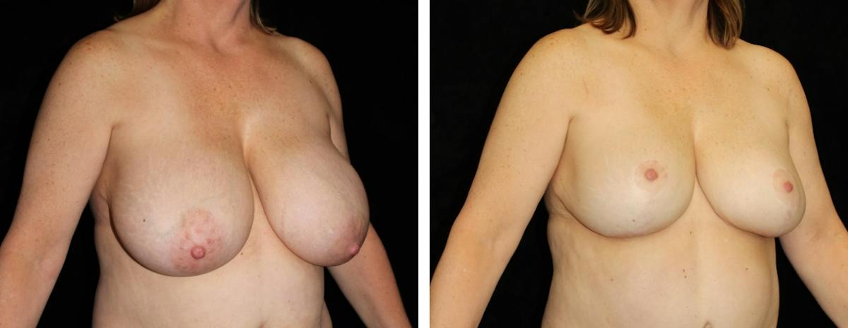 Breast Reduction Before & After Gallery - Patient 188712 - Image 2