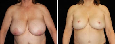 Breast Reduction Before & After Gallery - Patient 188712 - Image 1