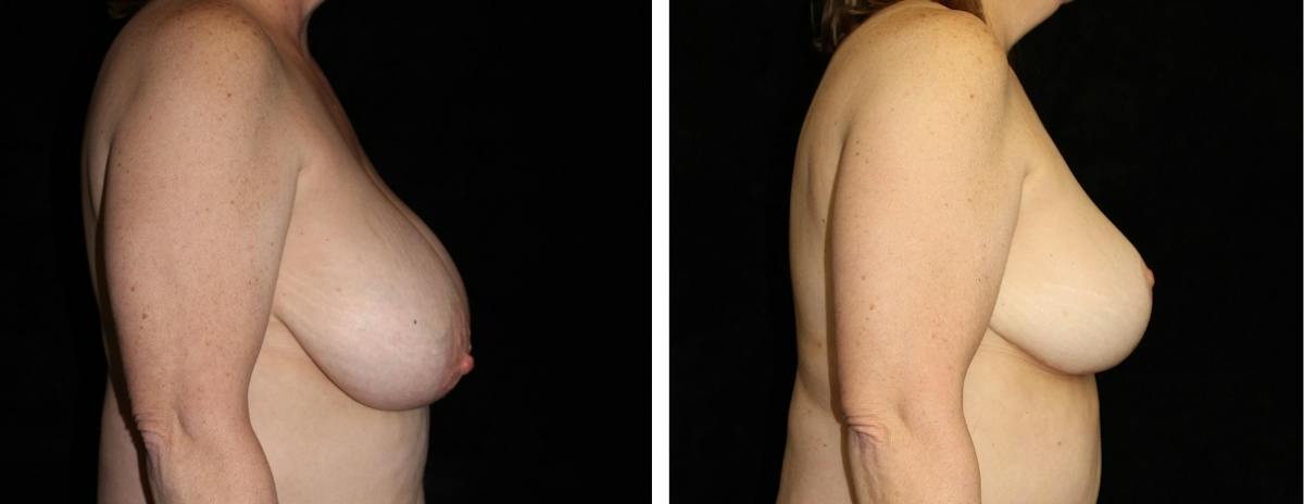 Breast Reduction Before & After Gallery - Patient 188712 - Image 3