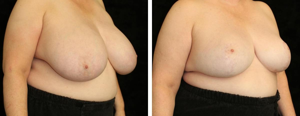 Breast Reduction Before & After Gallery - Patient 257257 - Image 2