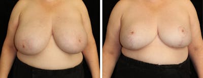 Breast Reduction Before & After Gallery - Patient 257257 - Image 1