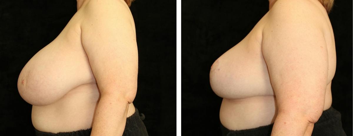 Breast Reduction Before & After Gallery - Patient 257257 - Image 3