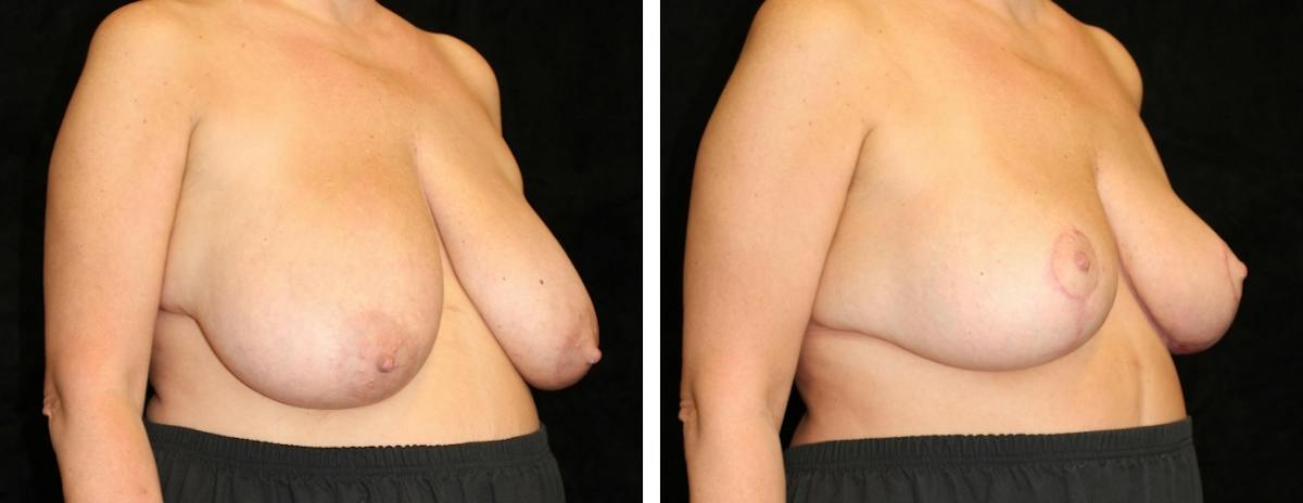 Breast Reduction Before & After Gallery - Patient 324683 - Image 2