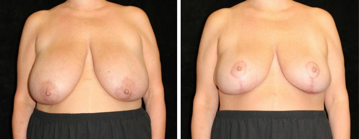 Breast Reduction Before & After Gallery - Patient 324683 - Image 1