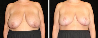 Breast Reduction Before & After Gallery - Patient 324683 - Image 1