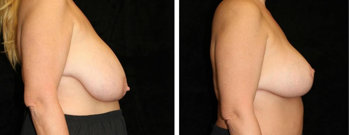 Breast Reduction Before & After Gallery - Patient 324683 - Image 3