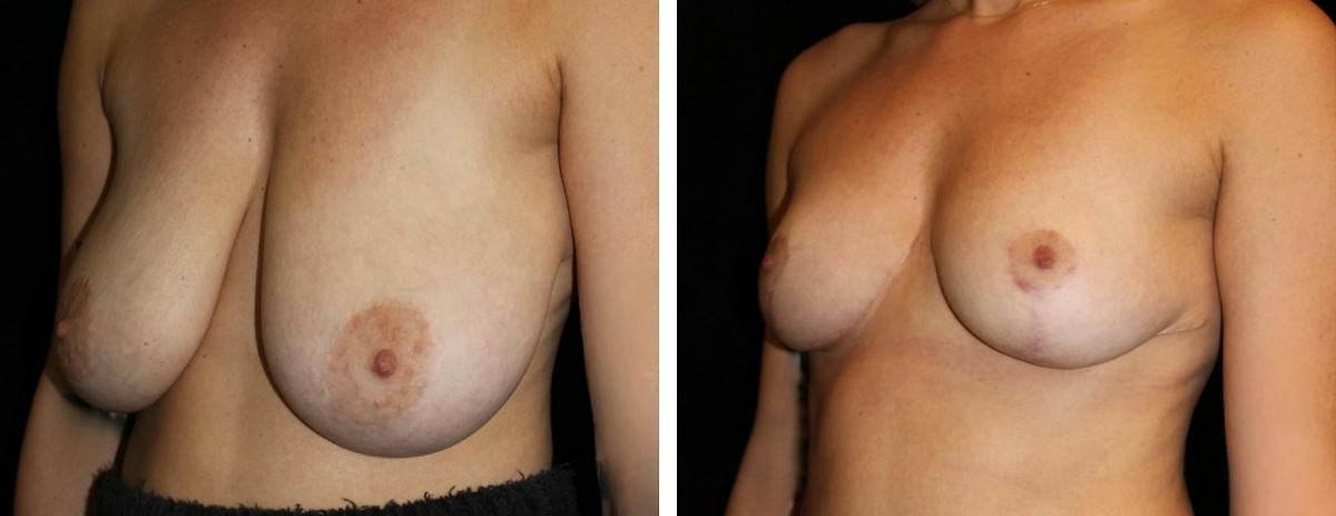 Breast Reduction Before & After Gallery - Patient 133260 - Image 2