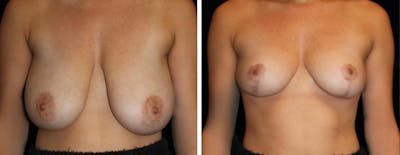 Breast Reduction Before & After Gallery - Patient 133260 - Image 1