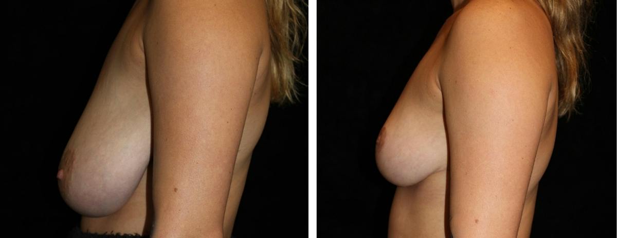 Breast Reduction Before & After Gallery - Patient 133260 - Image 3