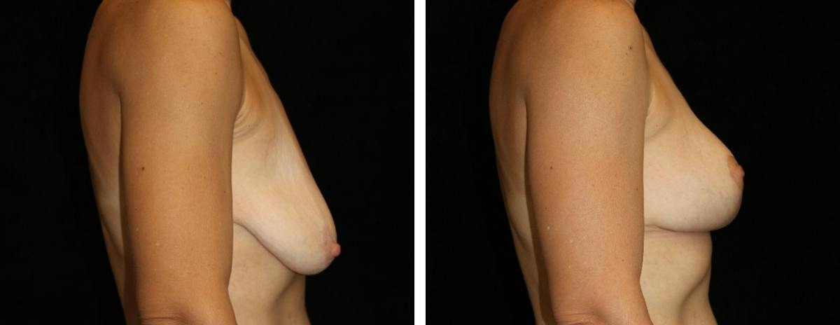 Breast Reduction Before & After Gallery - Patient 822840 - Image 3