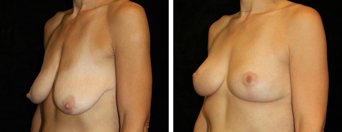Breast Reduction Before & After Gallery - Patient 822840 - Image 2