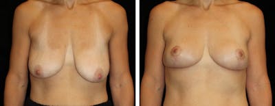 Breast Reduction Before & After Gallery - Patient 822840 - Image 1