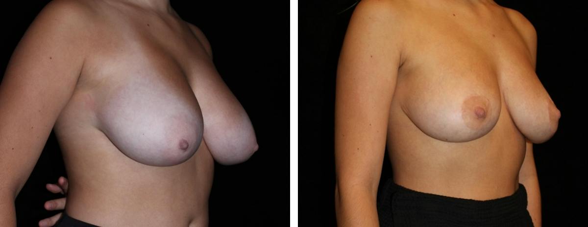 Breast Reduction Before & After Gallery - Patient 318826 - Image 2
