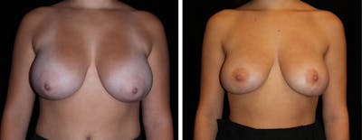 Breast Reduction Before & After Gallery - Patient 318826 - Image 1
