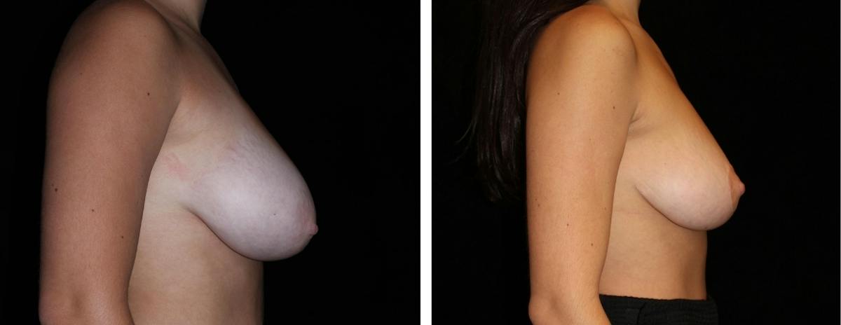 Breast Reduction Before & After Gallery - Patient 318826 - Image 3