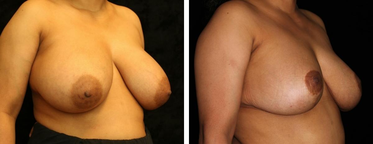 Breast Reduction Before & After Gallery - Patient 189280 - Image 2