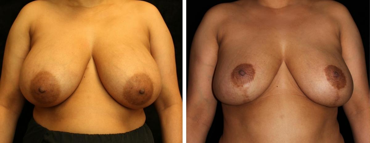 Breast Reduction Before & After Gallery - Patient 189280 - Image 1