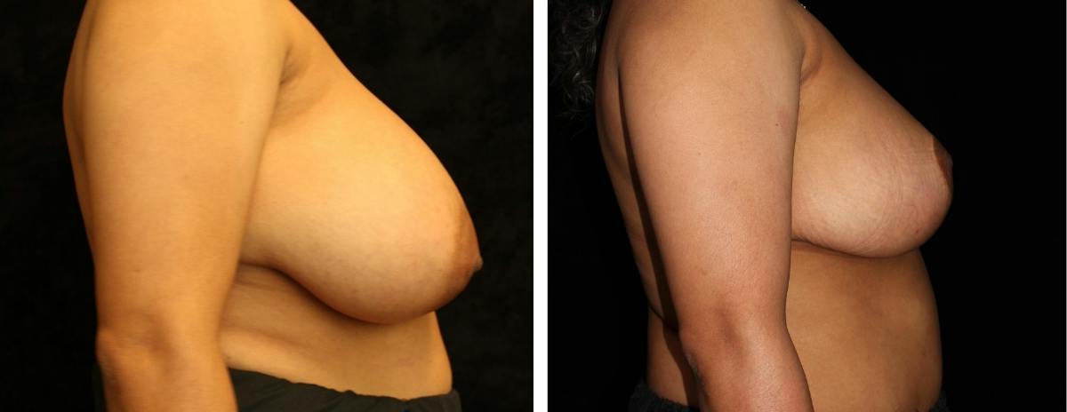 Breast Reduction Before & After Gallery - Patient 189280 - Image 3