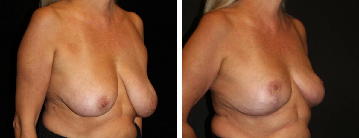 Breast Reduction Before & After Gallery - Patient 369789 - Image 2