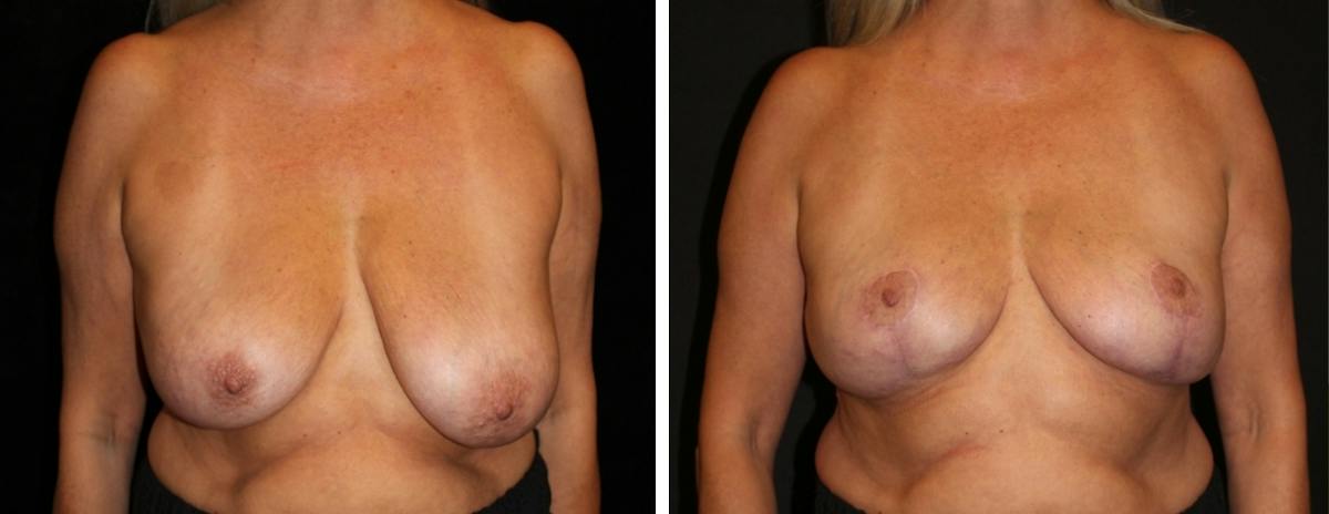 Breast Reduction Before & After Gallery - Patient 369789 - Image 1