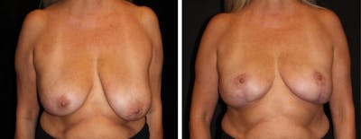 Breast Reduction Before & After Gallery - Patient 369789 - Image 1