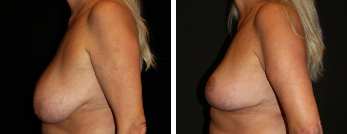 Breast Reduction Before & After Gallery - Patient 369789 - Image 3