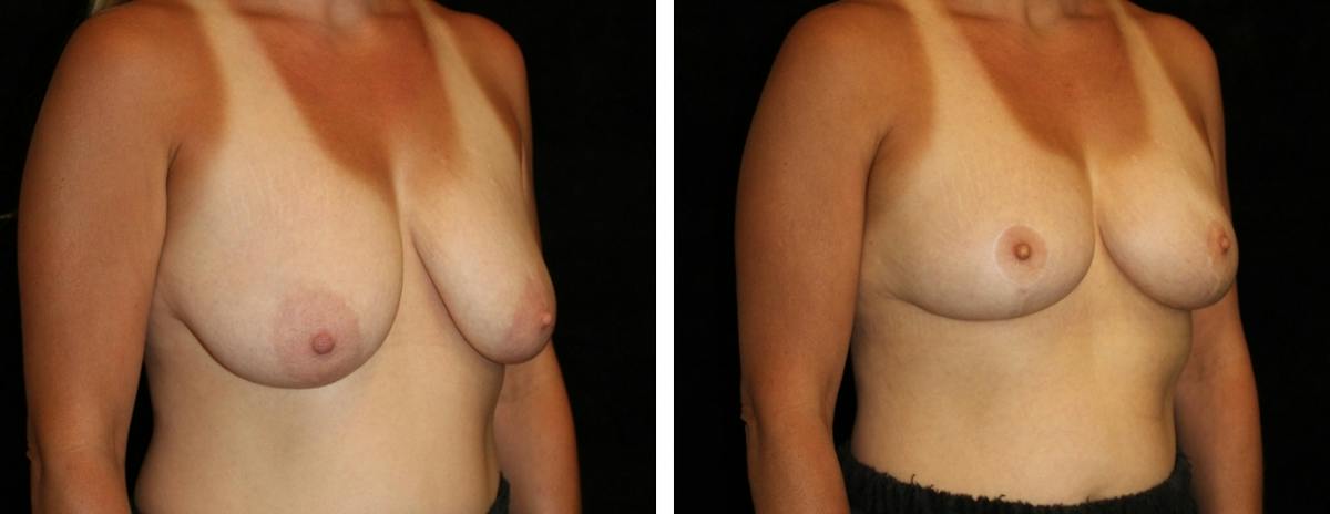 Breast Reduction Before & After Gallery - Patient 394656 - Image 2