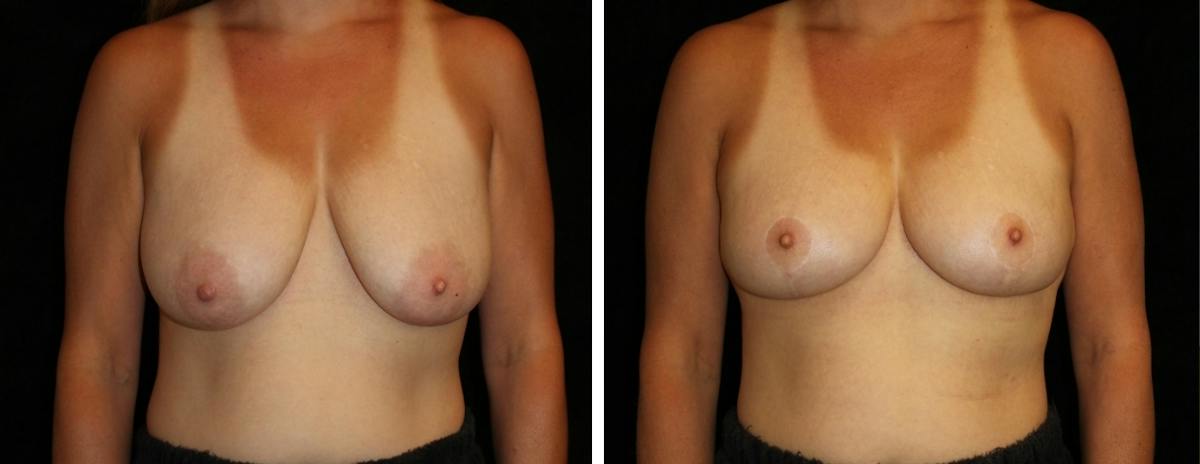 Breast Reduction Before & After Gallery - Patient 394656 - Image 1