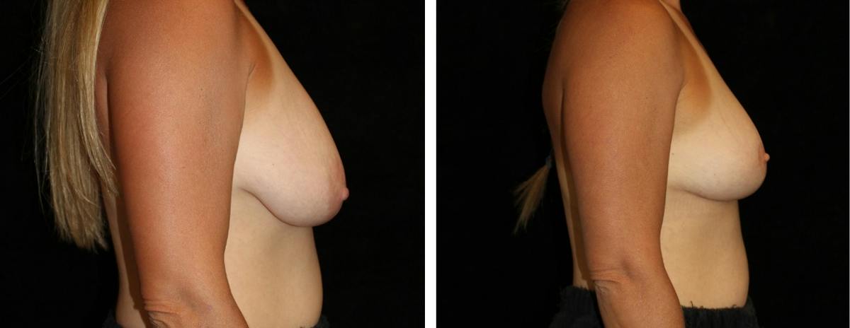Breast Reduction Before & After Gallery - Patient 394656 - Image 3