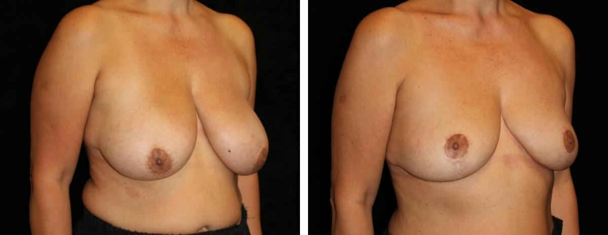Breast Reduction Before & After Gallery - Patient 311017 - Image 2