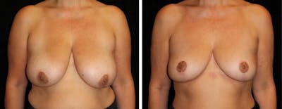 Breast Reduction Before & After Gallery - Patient 311017 - Image 1