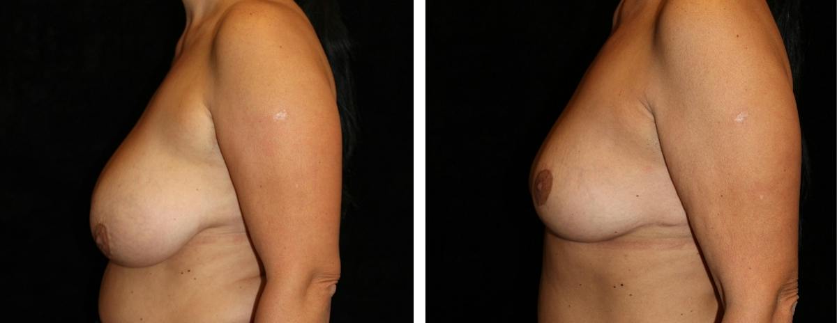 Breast Reduction Before & After Gallery - Patient 311017 - Image 3