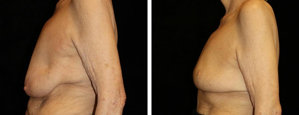 Breast Reduction Before & After Gallery - Patient 330464 - Image 3