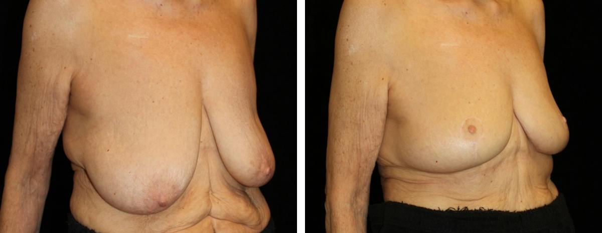 Breast Reduction Before & After Gallery - Patient 330464 - Image 2