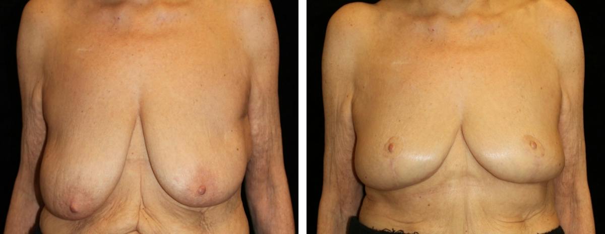 Breast Reduction Before & After Gallery - Patient 330464 - Image 1