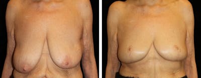 Breast Reduction Before & After Gallery - Patient 330464 - Image 1