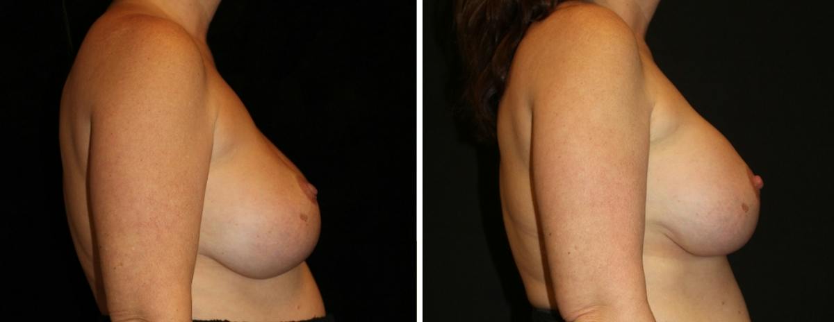 Breast Revision Before & After Gallery - Patient 205255 - Image 3