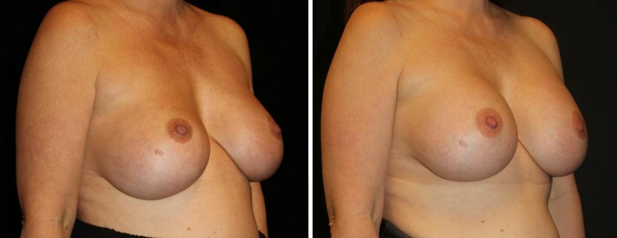 Breast Revision Before & After Gallery - Patient 205255 - Image 2